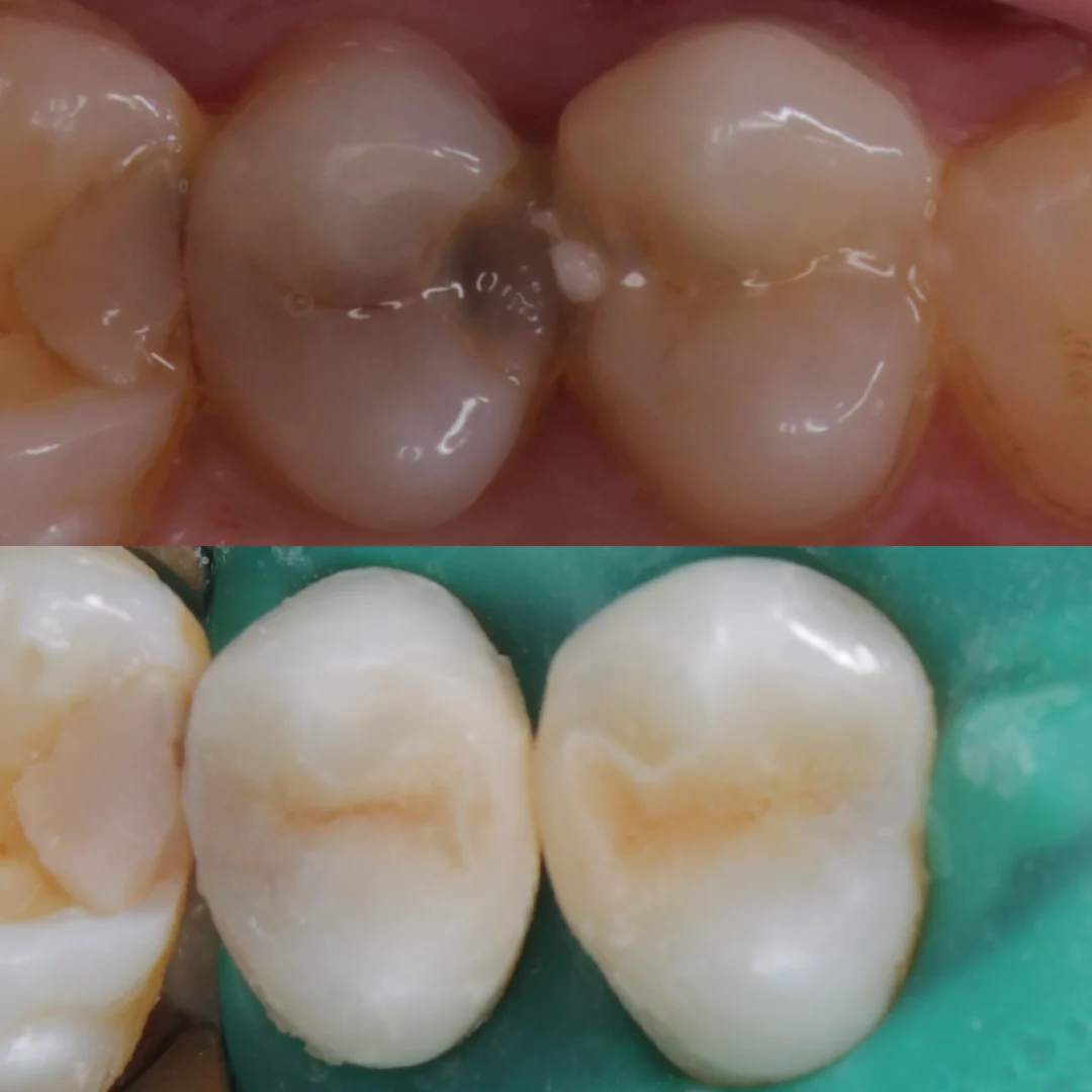Лечение кариеса